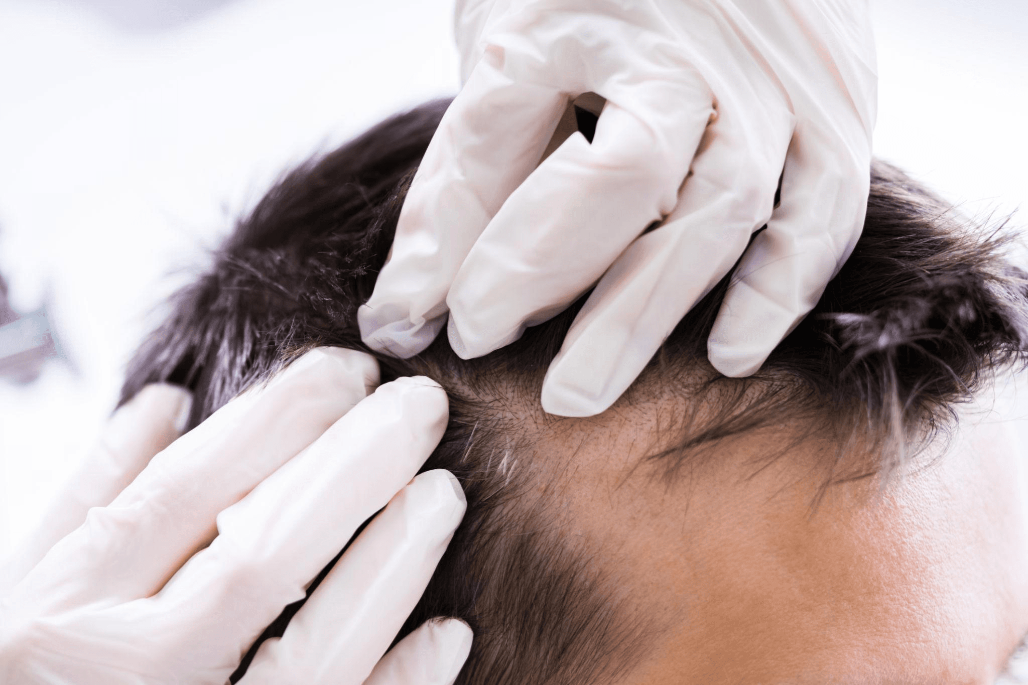 Hair Loss Treatment